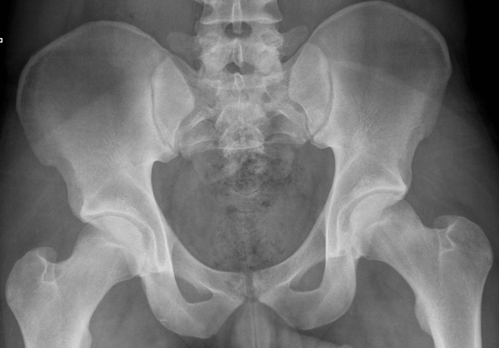 X-ray pelvis