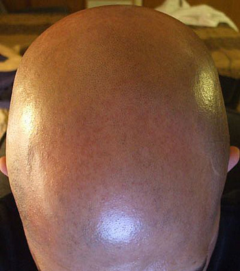 Baldy