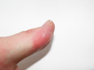 Blistered thumb
