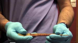 Awang’s splinter.png
