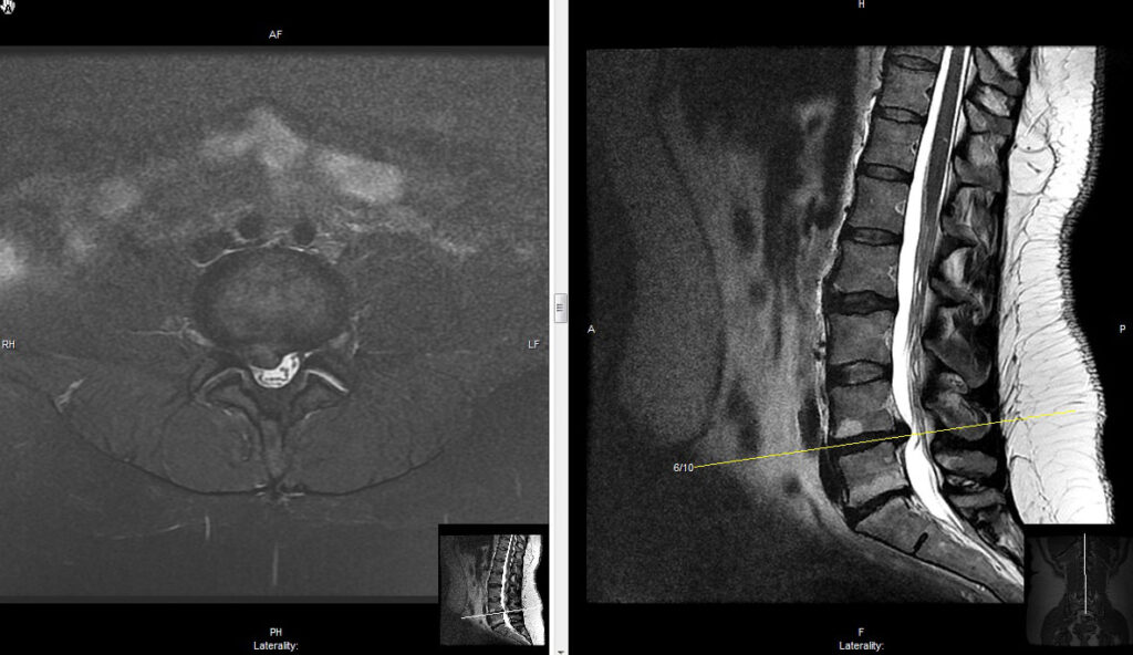 Herniated disc