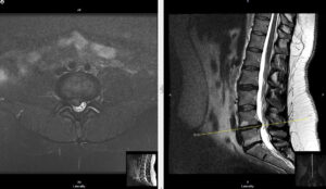 Herniated disc