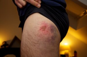 Bike bruise