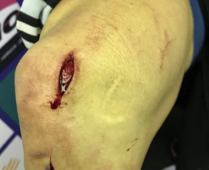 katie compton disc brake injury.png