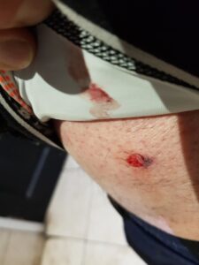 Cyclist shot with air rifle pellet