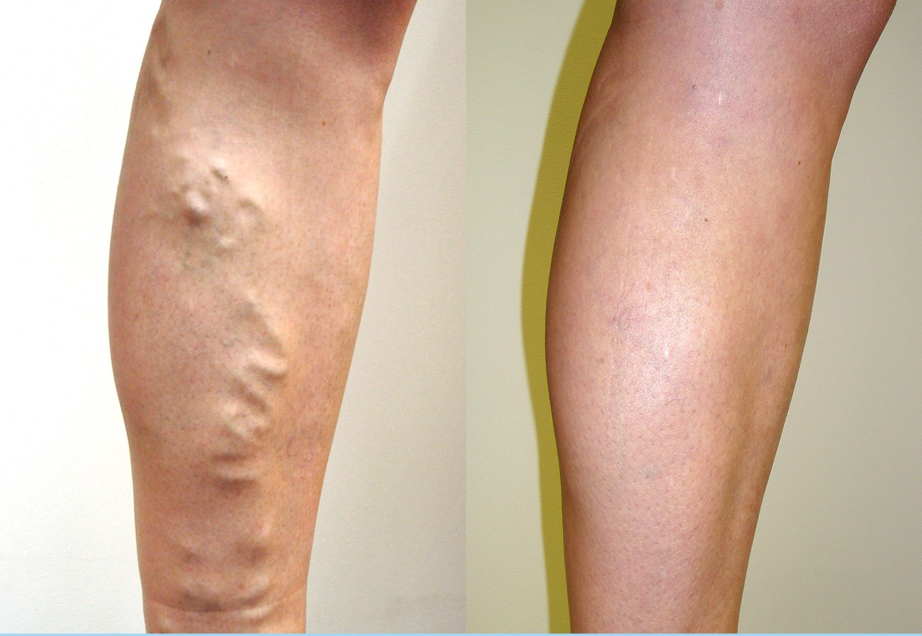 before-after-treatment-6Months