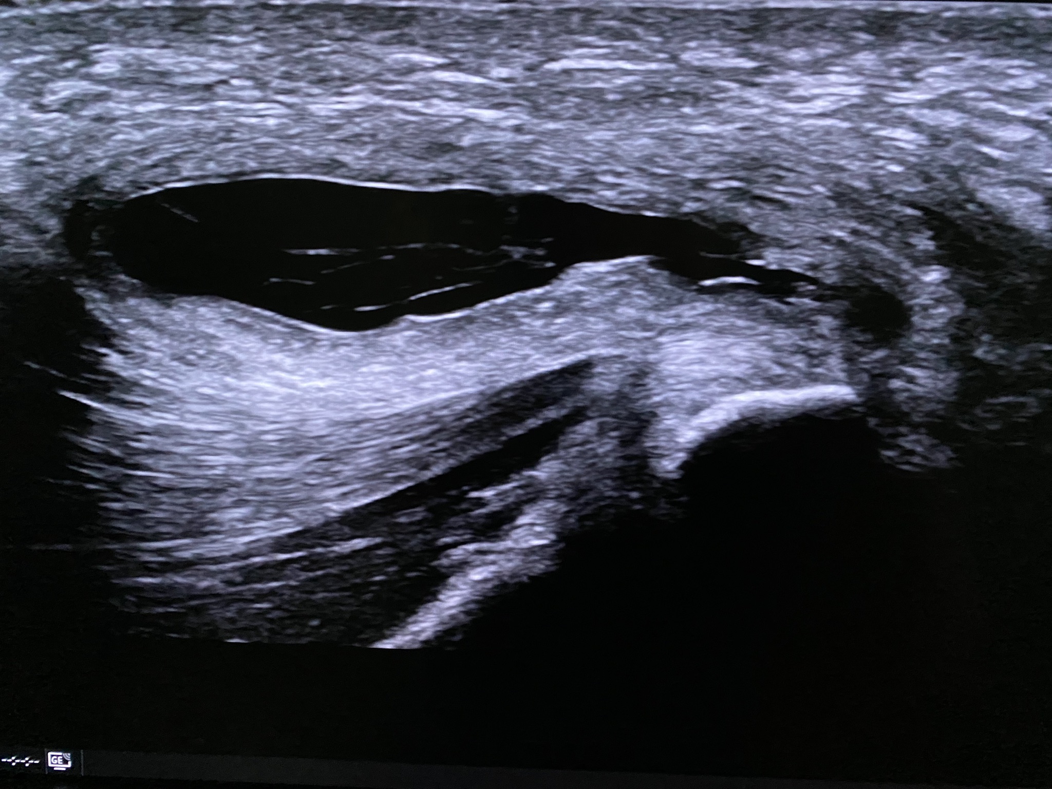 Ischial bursitis