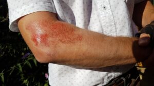 John B injury