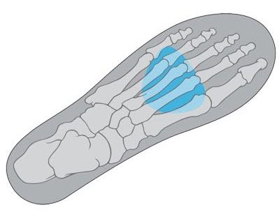 Specialized Metatarsal Button