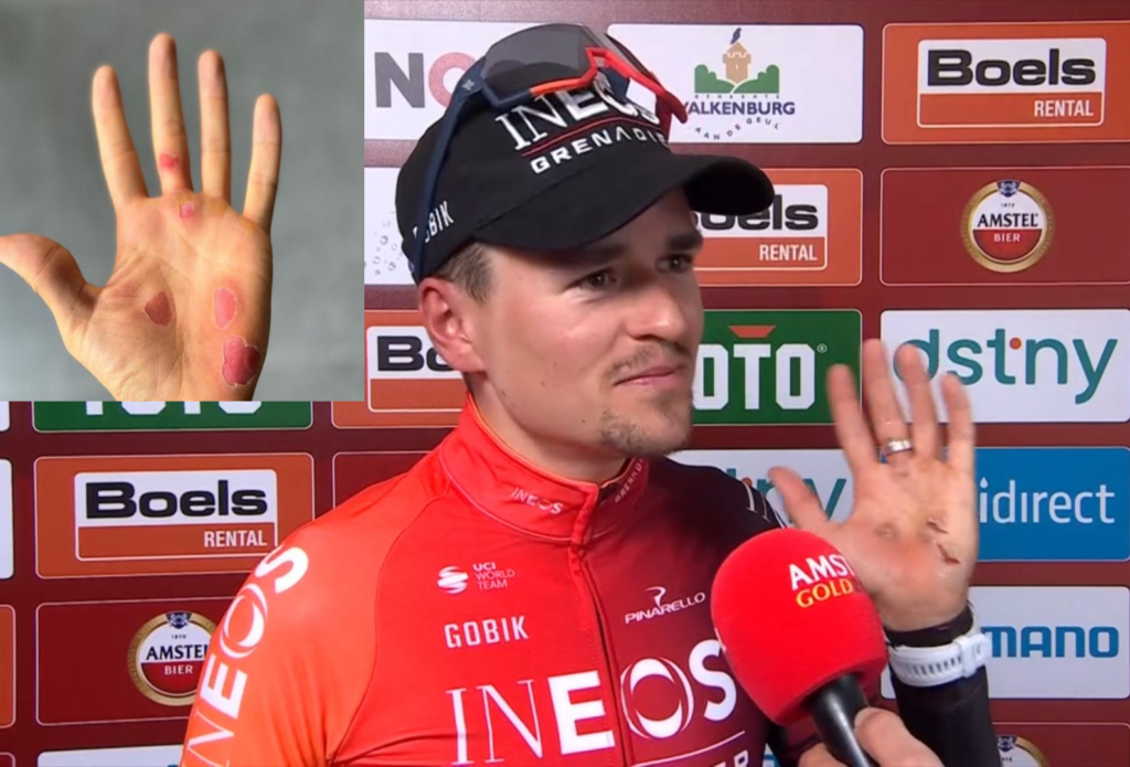 Tom Pidcock shows off Paris-Roubaix blisters having won Amstel Gold