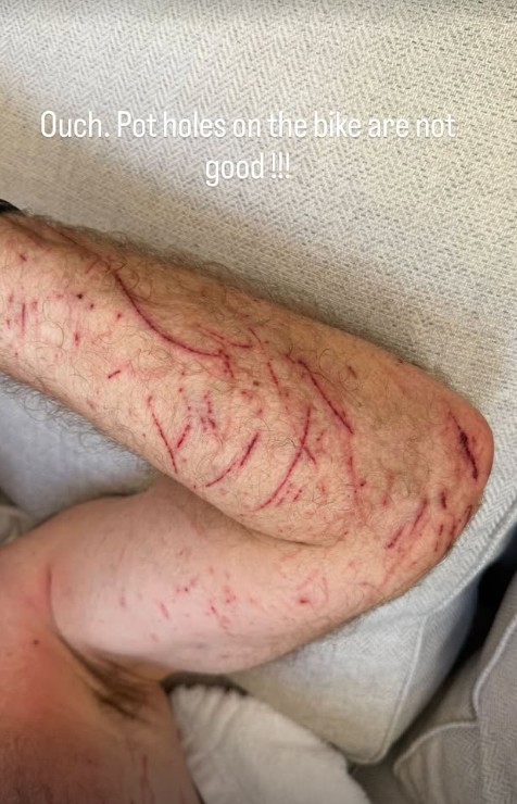 Alan Shearer arm cut