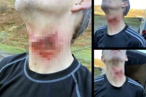 neck-injury-toecutter71-instagram.jpeg