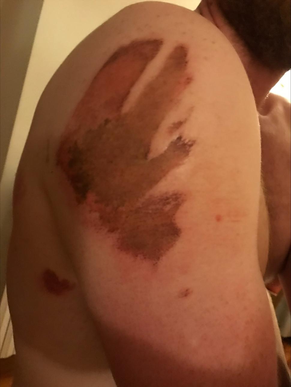 Road rash