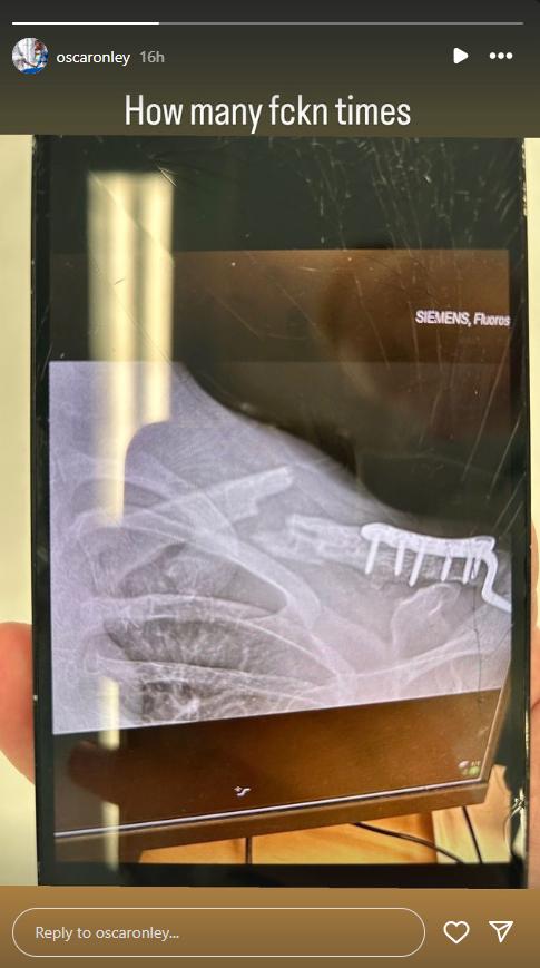 Oscar Onley broken collarbone Instagram story