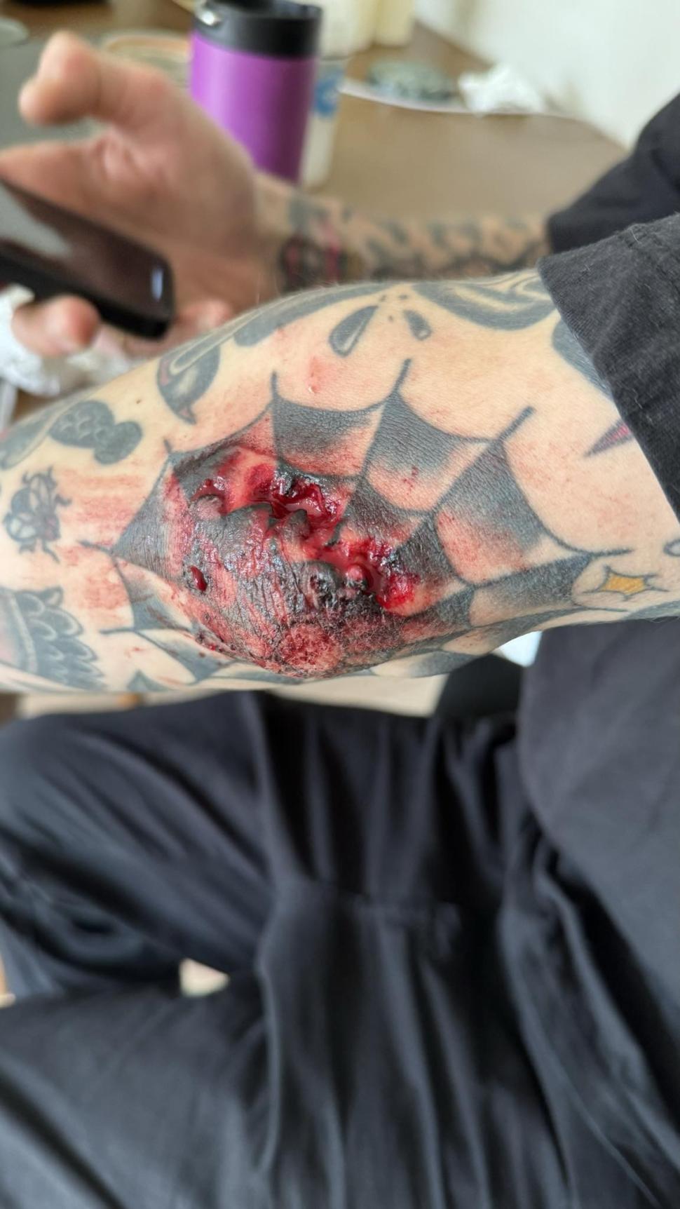 Patrick Hughes elbow injury