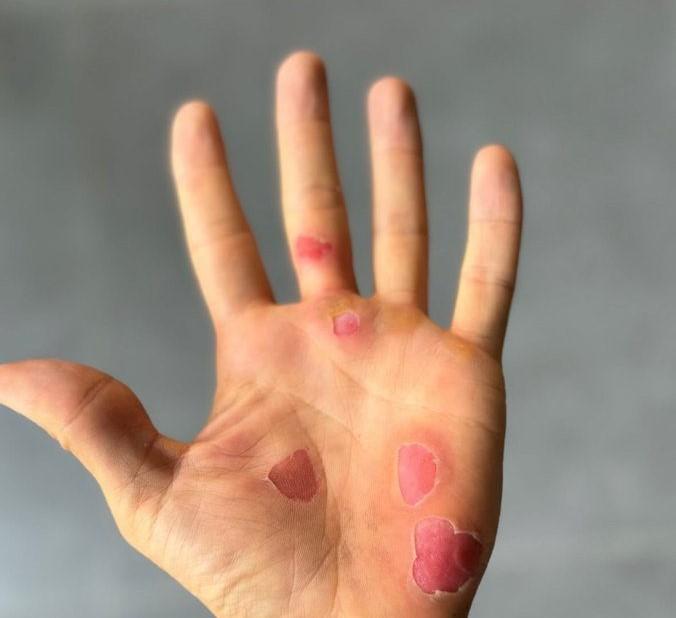 Tom Pidcock hand post-Roubaix (Instagram/Tom Pidcock)