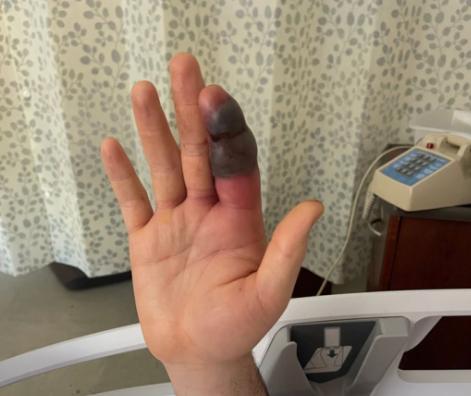 Cyclist bitten by snake